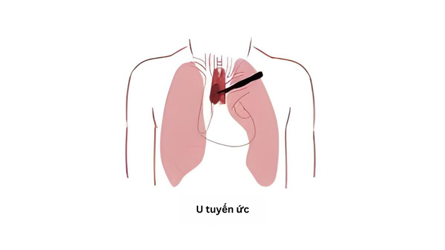 u tuyến ức