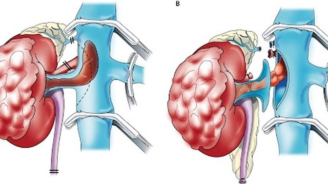 bai-viet/ung-thu-bieu-mo-than-dang-nhu-di-truyen-59032.html