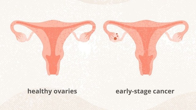 benh/ung-thu-buong-trung-giai-doan-1.html