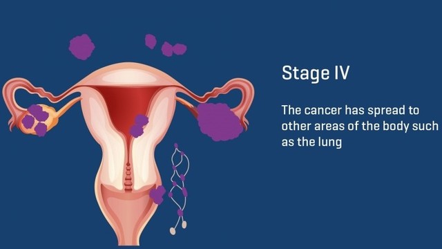 benh/ung-thu-buong-trung-giai-doan-4.html