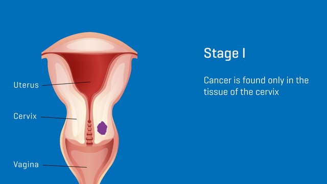 benh/ung-thu-co-tu-cung-giai-doan-1.html
