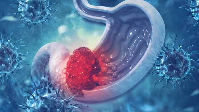 bai-viet/ung-thu-da-day-di-can-buong-trung-dau-hieu-tien-luong-va-dieu-tri.html