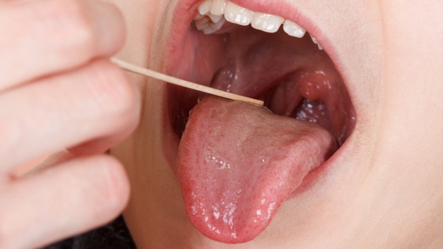 benh/ung-thu-khoang-mieng.html