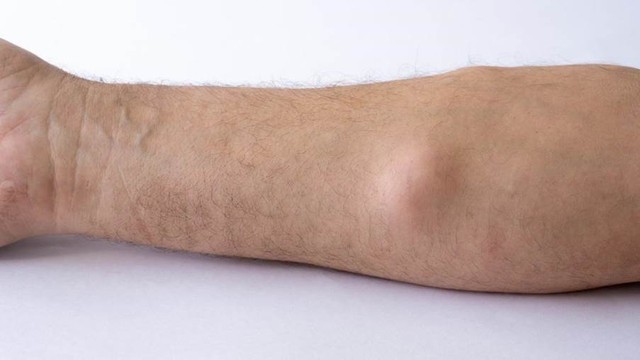 benh/ung-thu-mo-mo.html