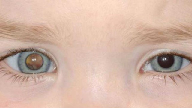 bai-viet/ung-thu-nguyen-bao-vong-mac-nguyen-nhan-trieu-chung-va-cach-dieu-tri-55914.html