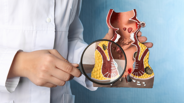 benh/ung-thu-ong-hau-mon-389.html