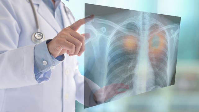 bai-viet/ung-thu-phoi-te-bao-nho-giai-doan-lan-tran-va-nhung-dieu-can-biet.html