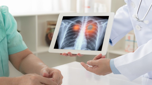 bai-viet/ung-thu-phoi-te-bao-nho-la-gi-trieu-chung-va-phuong-phap-dieu-tri-hien-nay.html