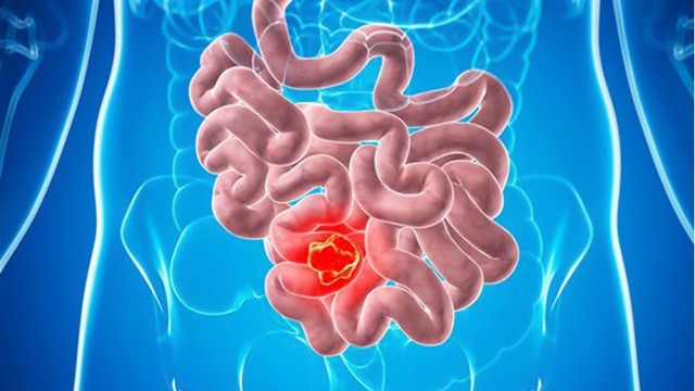 bai-viet/ung-thu-ruot-non-co-nguy-hiem-khong-dau-hieu-va-cach-dieu-tri.html