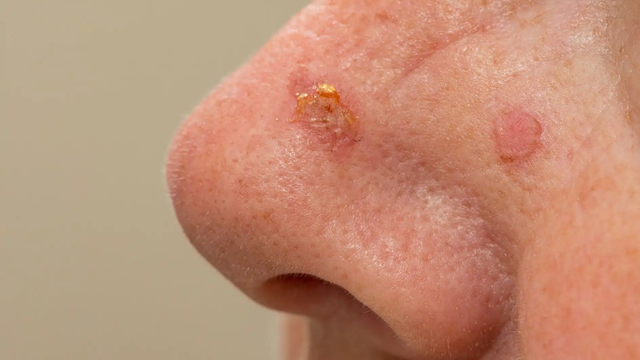 Ung thư tế bào vảy là gì? Triệu chứng, nguyên nhân, chẩn đoán và điều trị bệnh 3