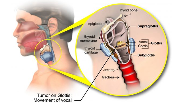 bai-viet/ung-thu-thanh-quan-nguyen-nhan-trieu-chung-chan-doan-va-dieu-tri-60919.html