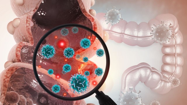 benh/ung-thu-truc-trang-giai-doan-2.html