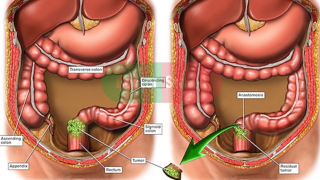 benh/ung-thu-truc-trang-giai-doan-4.html