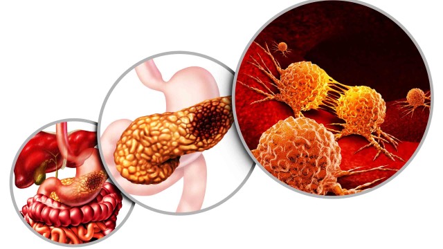 bai-viet/ung-thu-tuy-ngoai-tiet-yeu-to-nguy-co-va-cach-dieu-tri.html