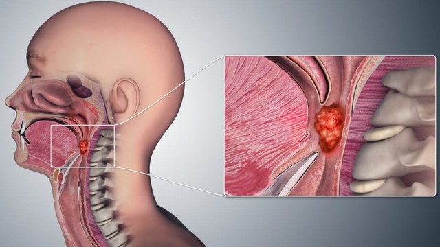 benh/ung-thu-vom-hong-327.html