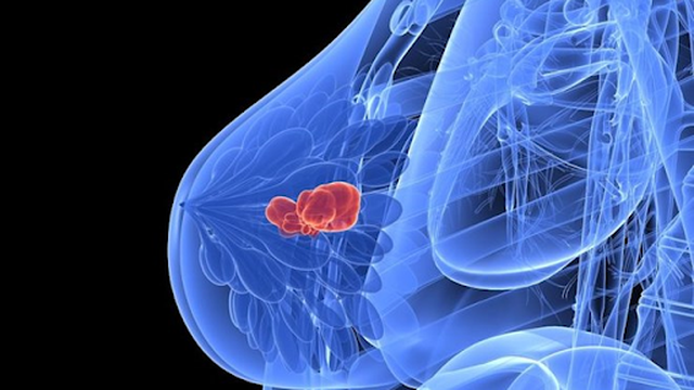 bai-viet/ung-thu-vu-di-can-nao-duoc-dieu-tri-nhu-the-nao-59117.html