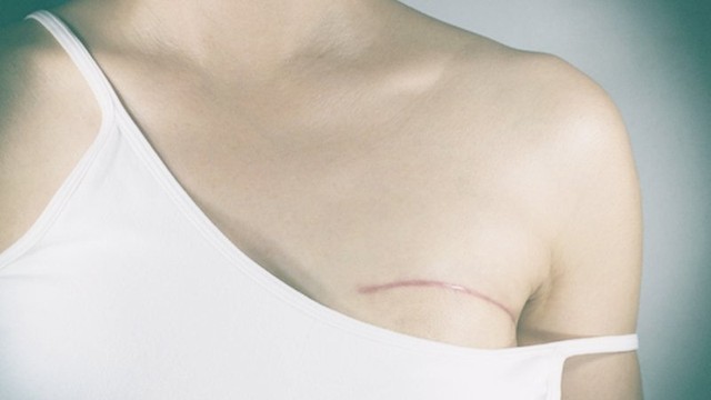 bai-viet/ung-thu-vu-the-tuy-la-gi-54573.html