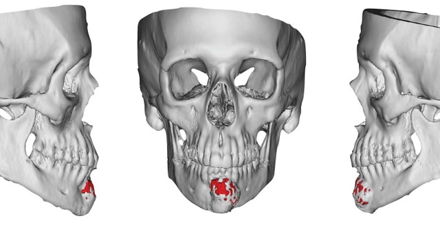 benh/ung-thu-xuong-ham.html