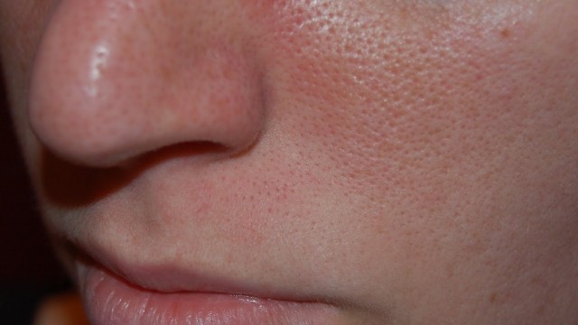 bai-viet/uong-dau-gac-bi-noi-mun-va-nhung-luu-y-khi-su-dung-dau-gac-an-toan-61917.html