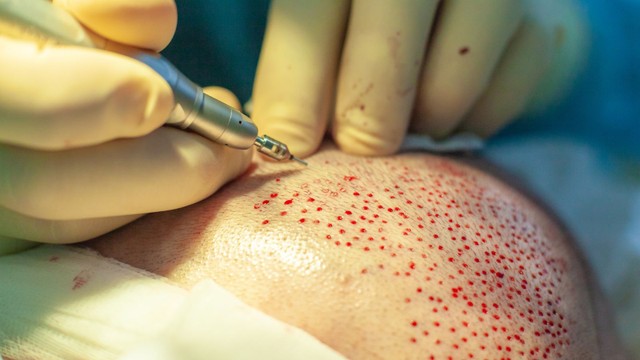 bai-viet/uu-va-nhuoc-diem-cua-phuong-phap-cay-toc-fue-la-gi.html