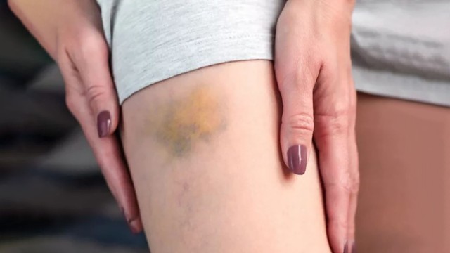 bai-viet/vet-bam-tim-bao-lau-thi-het-nguyen-nhan-va-cach-xu-ly.html