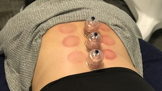 bai-viet/vi-sao-co-vet-bam-tim-khi-giac-hoi-co-anh-huong-den-suc-khoe-khong.html