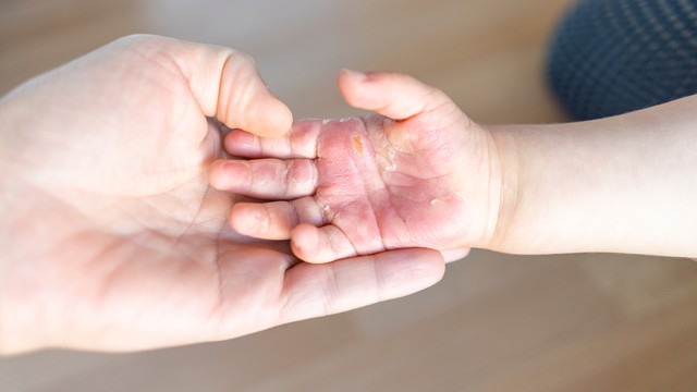 bai-viet/vet-bong-bi-phong-nuoc-phai-lam-sao.html