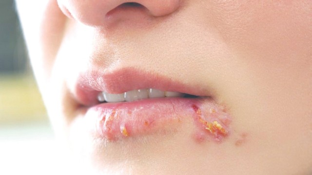 bai-viet/vet-loet-lanh-la-gi-vet-loet-lanh-co-trieu-chung-nhu-the-nao.html