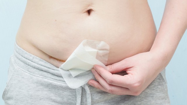 bai-viet/vet-mo-de-lan-2-bao-lau-thi-lanh-cach-giup-vet-mo-de-nhanh-lanh.html