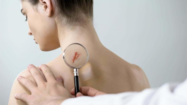 bai-viet/cach-khac-phuc-vet-seo-va-han-che-de-lai-seo-hieu-qua-khi-bi-vet-thuong.html