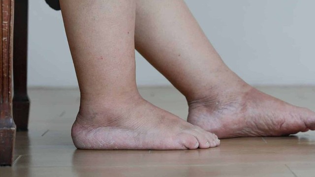 bai-viet/ung-thu-giai-doan-cuoi-bi-phu-chan-la-do-dau-bien-phap-giam-phu-chan-hieu-qua.html