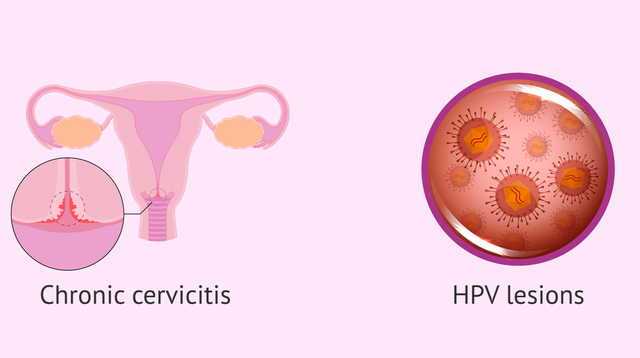 bai-viet/vi-sao-phu-nu-lai-de-bi-viem-co-tu-cung-man-tinh-cach-phong-benh-hieu-qua.html