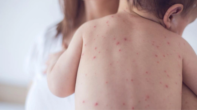 bai-viet/vi-sao-soi-va-sot-phat-ban-thuong-de-nham-lan-cach-phan-biet-soi-va-sot-phat-ban.html