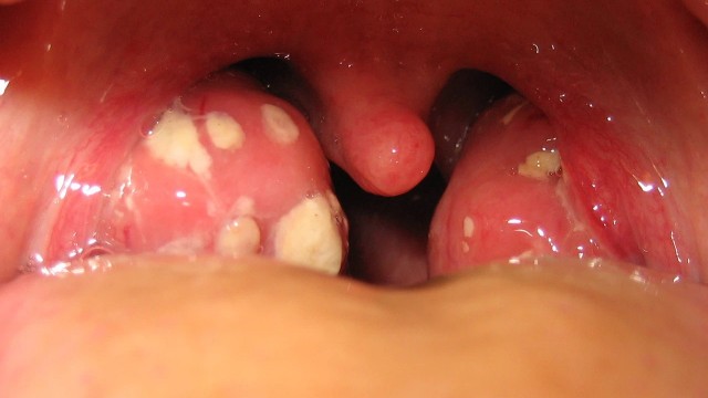 bai-viet/viem-amidan-hoc-mu-co-tu-khoi-khong-73093.html