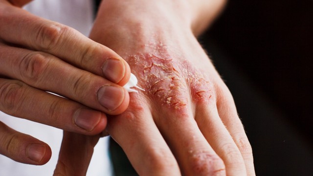 bai-viet/viem-da-ban-tay-va-nhung-dieu-ban-can-biet.html