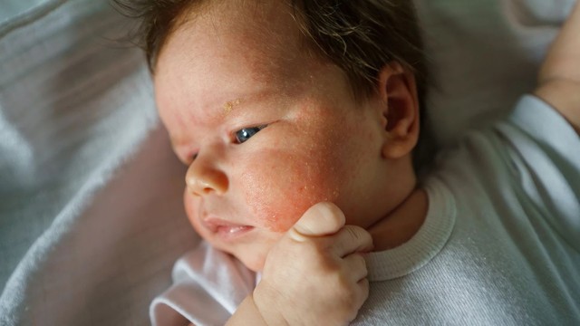 bai-viet/viem-da-co-dia-o-tre-so-sinh-co-dang-lo-khong-va-cach-dieu-tri-nhu-the-nao.html