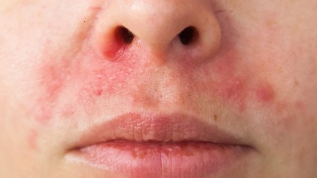 bai-viet/viem-da-dau-canh-mui-nguyen-nhan-trieu-chung-va-cach-khac-phuc.html