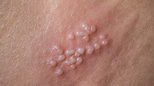 bai-viet/viem-da-lien-cau-la-gi-nguyen-nhan-trieu-chung-va-cach-dieu-tri.html