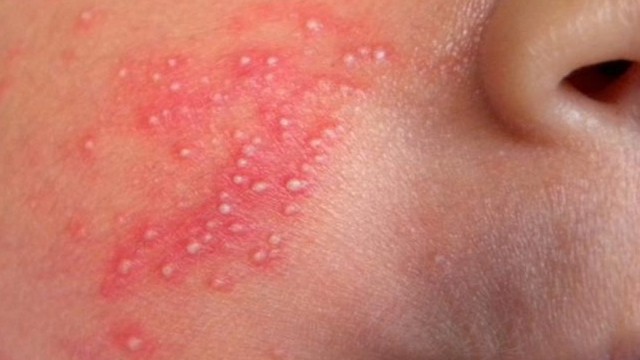 bai-viet/viem-da-mu-o-tre-so-sinh-bieu-hien-nhu-the-nao-phong-benh-viem-da-65911.html