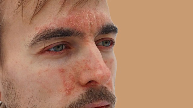 bai-viet/nguyen-nhan-trieu-chung-va-cach-dieu-tri-viem-da-tiet-ba-o-mat.html