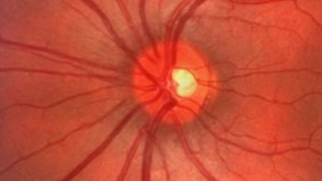 bai-viet/viem-gai-thi-than-kinh-nguyen-nhan-bieu-hien-phuong-phap-chan-doan-va-dieu-tri.html