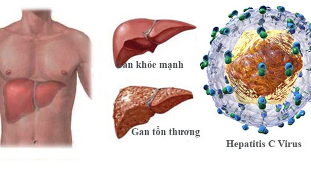 bai-viet/viem-gan-c-co-tu-khoi-khong-hieu-ro-ve-benh-va-cac-phuong-phap-dieu-tri.html