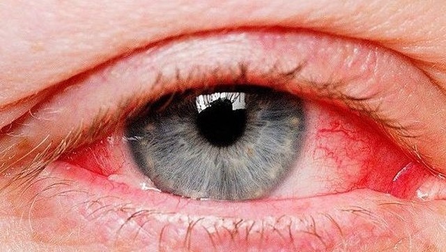 bai-viet/viem-giac-mac-co-lay-khong-cach-phong-tranh-viem-giac-mac-nhu-the-nao.html