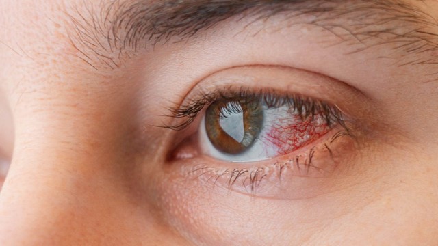 bai-viet/viem-giac-mac-co-nguy-hiem-khong-nhung-dieu-ban-can-biet.html