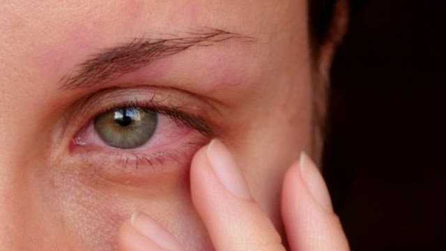 bai-viet/viem-giac-mac-kieng-an-gi-nguyen-nhan-va-dau-hieu-cua-viem-giac-mac.html