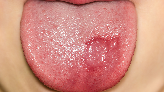 Viêm lưỡi bản đồ 0