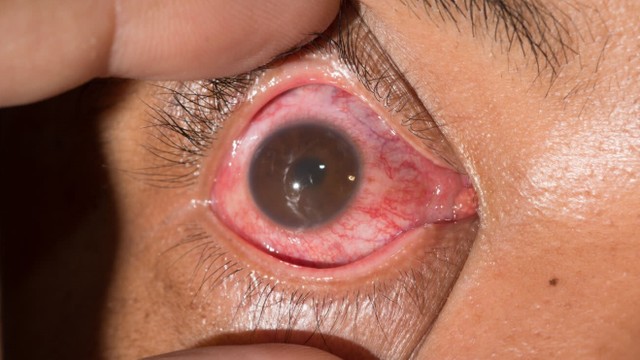 bai-viet/viem-mang-bo-dao-truoc-nguyen-nhan-trieu-chung-va-cach-dieu-tri.html