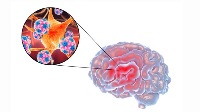 bai-viet/viem-mang-nao-do-hib-trieu-chung-va-phuong-phap-dieu-tri-hieu-qua.html