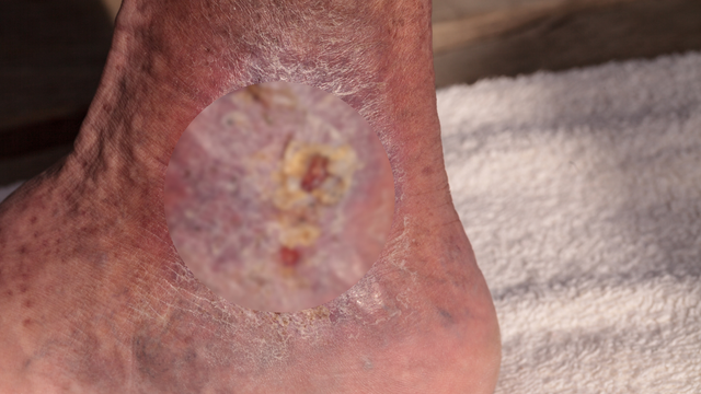 benh/viem-mo-te-bao.html