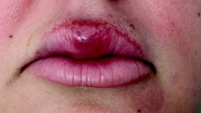 bai-viet/viem-moi-dang-u-hat-la-benh-gi-nguyen-nhan-gay-benh-va-dau-hieu-nhan-biet.html